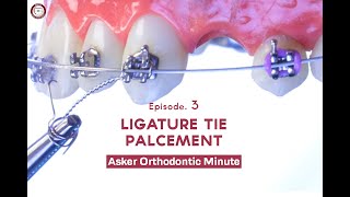 LIGATURE TIE Asker Orthodontic Minute Episode 3 [upl. by Hamian]