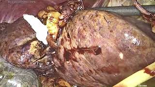 Central hepatectomy HCC [upl. by Anawot]