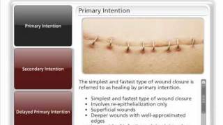 Types of Wound Closure [upl. by Nylsej]