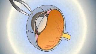 Cornea Transplant  2D Animation [upl. by Sesiom]