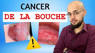 Cancer de la bouche  Les lésions précancéreuses à savoir reconnaitre [upl. by Mack]