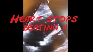 Cardiology Echo QuizCase Heart stops beating Part 1 SCD VT SVT AVRT AVNRT Sinus Tach [upl. by Littman677]