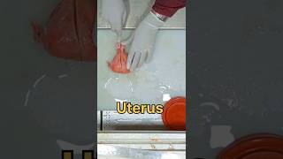 uterus with bilateral adnexa specimen [upl. by Gilman581]