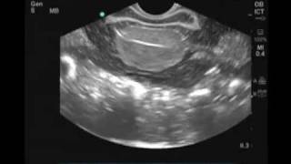 How to Female Transvaginal Ultrasound Exam [upl. by Nagem]