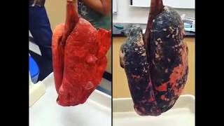 Smokers Lungs VS Nonsmokers Lungs [upl. by Scotty474]