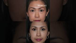 Blepharoplasty Eyebags Removal Surgery Before amp After  Dr Bashar Bizrah LondonDubai [upl. by Wenda]