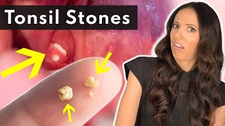 What Are Tonsil Stones amp How To SAFELY Remove Them [upl. by Ived]