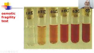 HERIDATARY SPHEROCYTOSIS FAVISM [upl. by Oedama]