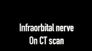 CT scan infraorbital nerve  Axial View [upl. by Amaleta]