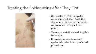 Treating Spider Vein Complexes Using a Combination of Tumescent amp Foam Sclerotherapy [upl. by Darci]