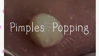 Pimples amp Blackheads Popping  59 [upl. by Flosser]