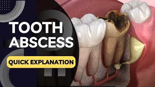 What is a Tooth Abscess Quickly Explained in a Few Seconds [upl. by Simons788]