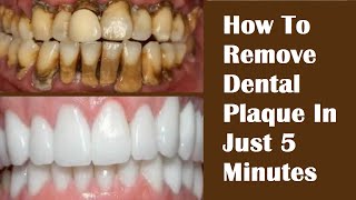 How To Remove Dental Plaque In Just 5 Minutes  Remove Tartar On Teeth FAST HealthyPunchToday [upl. by Tavie]