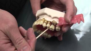 What is Periodontal Disease [upl. by Egdirdle]