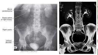 Radiographic Contrast Studies of the Urinary System [upl. by Nimesay]