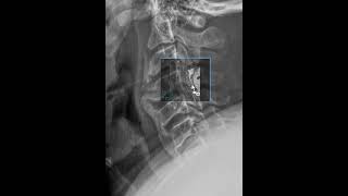 Diffuse Idiopathic Skeletal Hyperostosis DISH [upl. by Mosora]