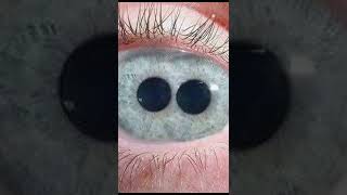 facts about Double pupils polycoria shorts [upl. by Ninette]