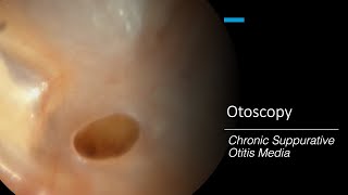 Chronic Suppurative Otitis Media Otoscopy [upl. by Yenahteb]