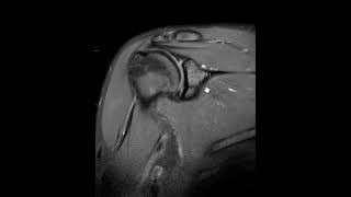 How does a post arthrogram MRI shoulder compare to a non contrast MRI for labral tear [upl. by Applegate225]