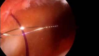 Arthroscopic Medial patella plication Dr A Reznik [upl. by Eugaet351]