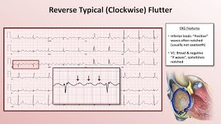 Advanced EKGs  The Subtypes of Atrial Flutter typical vs reverse typical vs atypical [upl. by Imotas]