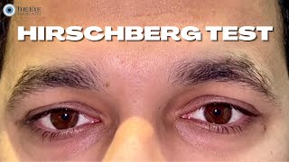 Hirschberg Test [upl. by Polak]