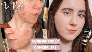 Best Concealers For ACNE PRONE SKIN  Scarring amp Pigmentation  NonComdogenic [upl. by Aneis]