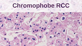 Chromophobe Renal Cell Carcinoma [upl. by Ahseikram]