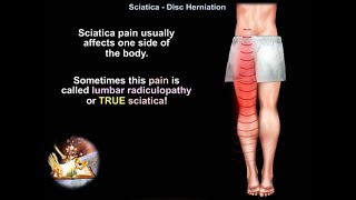 Low back pain Sciatica Disc Herniation  Everything You Need To Know  Dr Nabil Ebraheim [upl. by Gipsy]