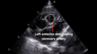 quot Coronary Arteries quot Usual amp Unsusual Echo Views [upl. by Tabb]