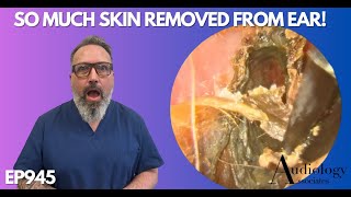 SO MUCH SKIN REMOVED FROM PATIENTS EAR CANAL  EP945 [upl. by Anoerb275]