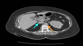 Clinical Case Renal Cell Carcinoma [upl. by Innek960]