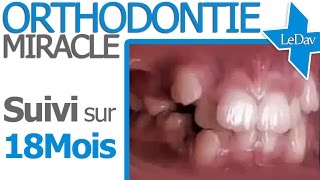 APPAREIL DENTAIRE Suivi Photo 18 MOIS  Traitement Orthodontie [upl. by Danuloff]