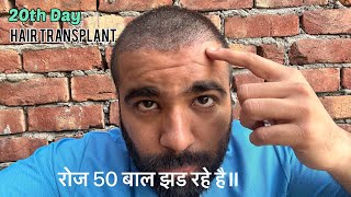 My Hair Transplant Results after 20 Days  Shedding Phase Started  Recover Hair Transplant Centre [upl. by Malva340]