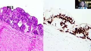 Tip82 Highgrade Appendiceal Mucinous Neoplasm [upl. by Thoma]