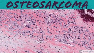 Osteosarcoma 101 Bone Pathology Basics [upl. by Olfe229]