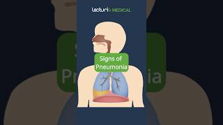 Recognizing the Signs of Pneumonia 🩺 MedicalEducation USMLE [upl. by Enyawal]