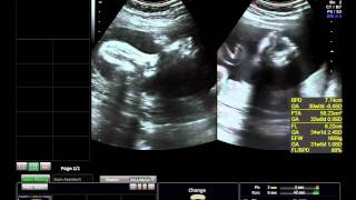 my BABYs Ultrasound at 30 weeks 4days amp baby was Breech [upl. by Atiuqal]