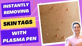 Plasma Fibroblast Treatment Say Goodbye To Skin Tags [upl. by Eenhat]