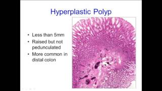 Hyperplastic Polyps Not Always What They Seem [upl. by Betteanne]