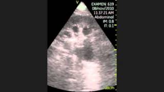 VSCAN Hydronephrosis grade III Pocket Ultrasound Hidronefrosis grado III Eco de bolsillo [upl. by Ainahpets]