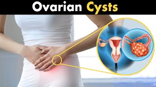 What is Ovarian Cysts  Types Causes and Symptoms [upl. by Airaet]