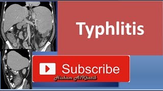 Typhlitis [upl. by Karen987]