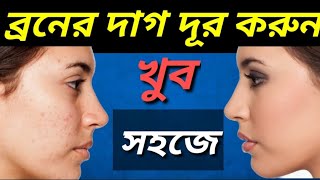 চিরতরে ব্রণের দাগ দূর করার সহজ উপায়  Broner Kalo Dag Dur Korar Bangla Health Tips bangla [upl. by Nautna]