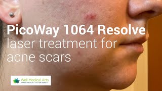 PicoWay 1064 Resolve for Acne scars Treatment 2 [upl. by Zug329]