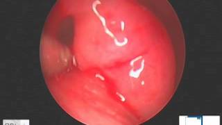 dilatation trompe dEustache  tuboplastie  balloon dilation of auditory tube [upl. by Cirdahc]