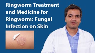 Ringworm Treatment Fungal Infection on Skin Symptoms Reason and Medicine for Ringworm Infection [upl. by Hulda]