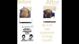 Best hair loss treatments [upl. by Avictor925]