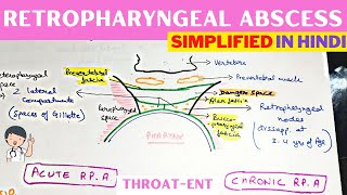 Retropharyngeal Abscess  Hindi  ENT [upl. by Etselec257]