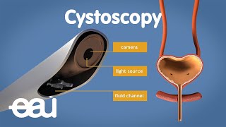 Cystoscopy overactive bladder [upl. by Sells]